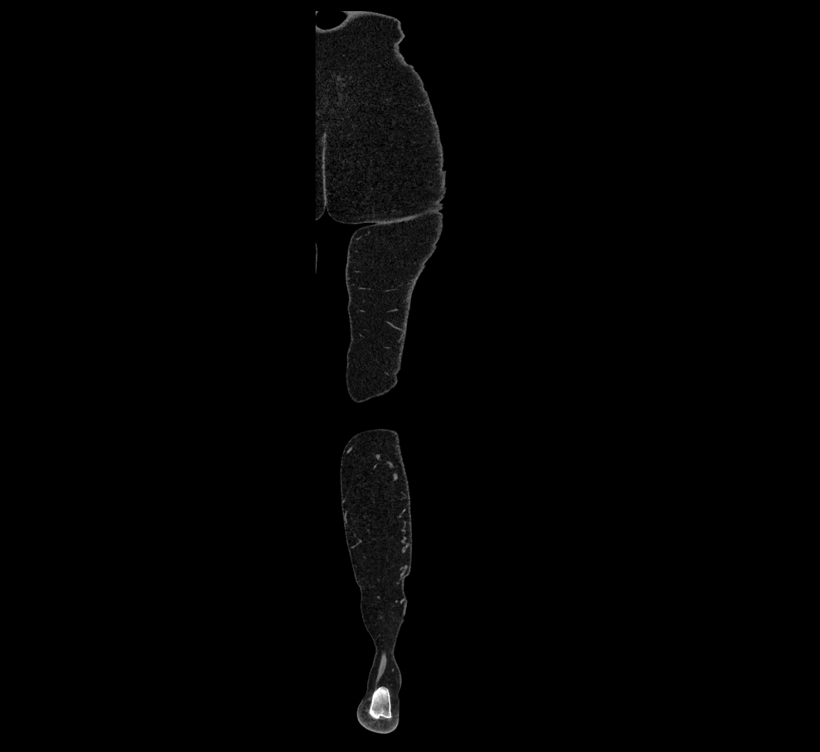CTA lower limb coronal cross sectional anatomy labelled image _91 (2).webp